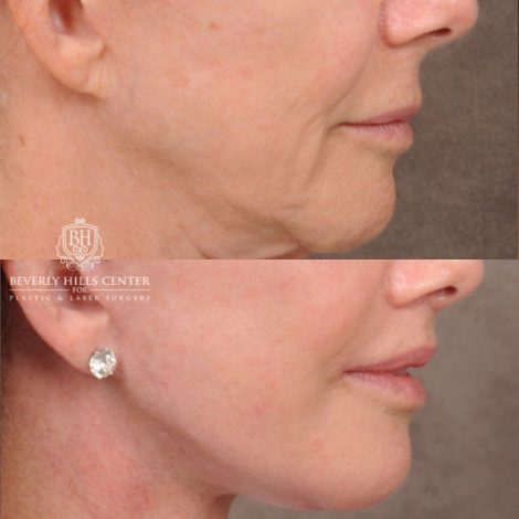 Beverly Hills Center Female Patient Before and After Comprehensive AuraLyft with CUPID LIFT® Corner Lift