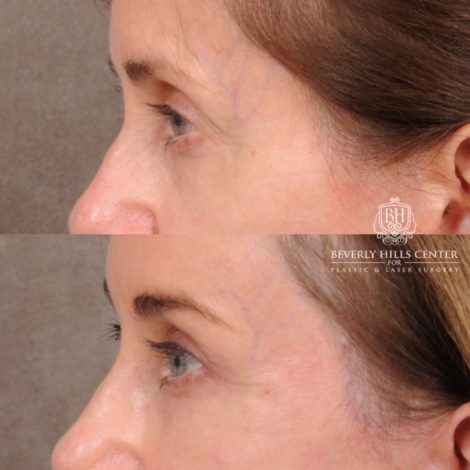 Beverly Hills Center Female Patient Before and After Comprehensive AuraLyft with CUPID LIFT® Corner Lift