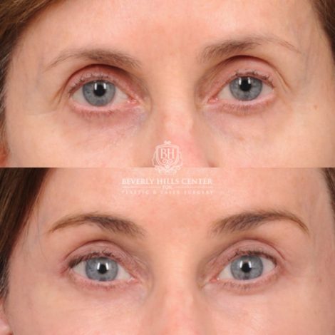 Beverly Hills Center Female Patient Before and After Comprehensive AuraLyft with CUPID LIFT® Corner Lift