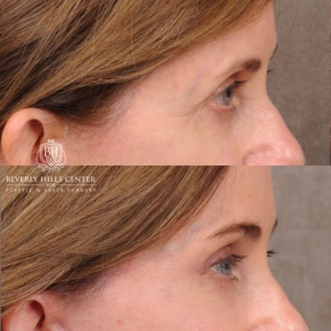 Beverly Hills Center Female Patient Before and After Comprehensive AuraLyft with CUPID LIFT® Corner Lift