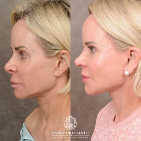 Beverly Hills Center Female Patient Before and After AuraLyft, Brow Lift, Upper Blepharoplasty, and CUPID LIFT® Lip Lift