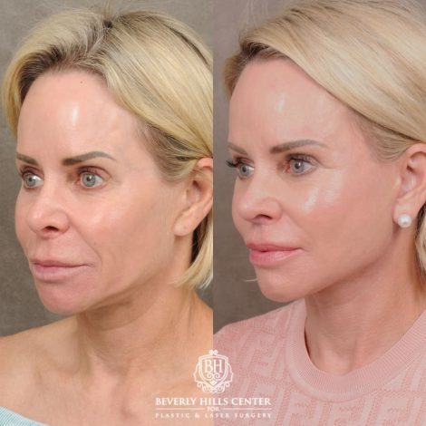Beverly Hills Center Female Patient Before and After AuraLyft, Brow Lift, Upper Blepharoplasty, and CUPID LIFT® Lip Lift