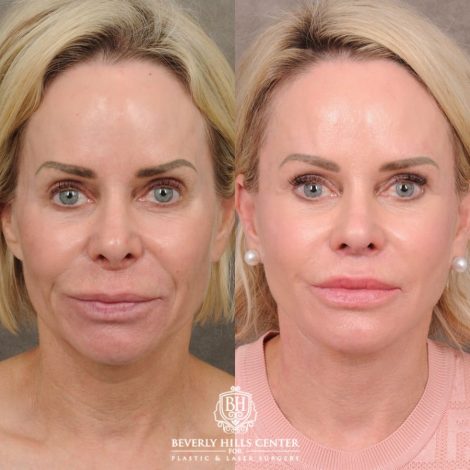 Beverly Hills Center Female Patient Before and After AuraLyft, Brow Lift, Upper Blepharoplasty, and CUPID LIFT® Lip Lift