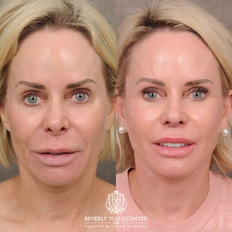 Beverly Hills Center Female Patient Before and After AuraLyft, Brow Lift, Upper Blepharoplasty, and CUPID LIFT® Lip Lift