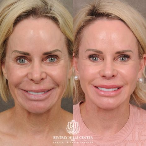 Beverly Hills Center Female Patient Before and After AuraLyft, Brow Lift, Upper Blepharoplasty, and CUPID LIFT® Lip Lift