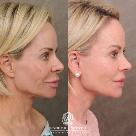 Beverly Hills Center Female Patient Before and After AuraLyft, Brow Lift, Upper Blepharoplasty, and CUPID LIFT® Lip Lift