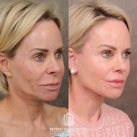 Beverly Hills Center Female Patient Before and After AuraLyft, Brow Lift, Upper Blepharoplasty, and CUPID LIFT® Lip Lift
