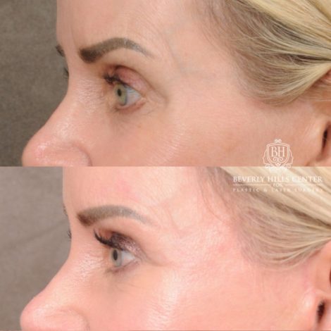Beverly Hills Center Female Patient Before and After AuraLyft, Brow Lift, Upper Blepharoplasty, and CUPID LIFT® Lip Lift