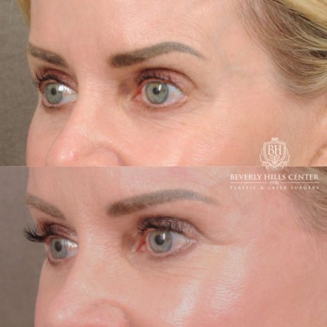 Beverly Hills Center Female Patient Before and After AuraLyft, Brow Lift, Upper Blepharoplasty, and CUPID LIFT® Lip Lift