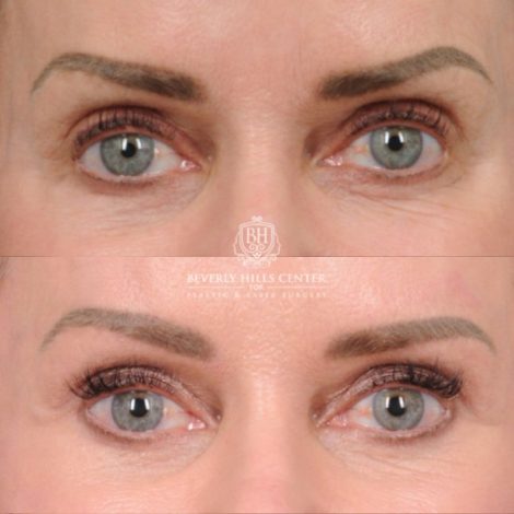 Beverly Hills Center Female Patient Before and After AuraLyft, Brow Lift, Upper Blepharoplasty, and CUPID LIFT® Lip Lift