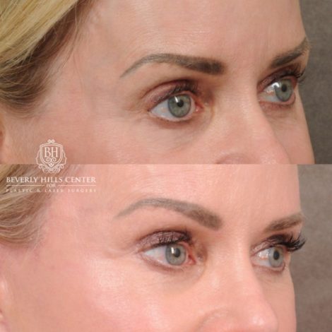 Beverly Hills Center Female Patient Before and After AuraLyft, Brow Lift, Upper Blepharoplasty, and CUPID LIFT® Lip Lift