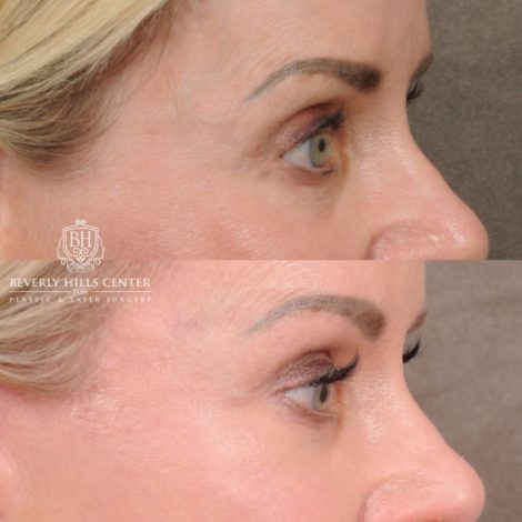 Beverly Hills Center Female Patient Before and After AuraLyft, Brow Lift, Upper Blepharoplasty, and CUPID LIFT® Lip Lift