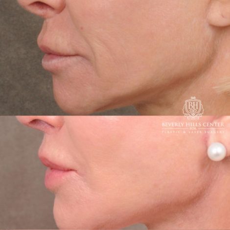 Beverly Hills Center Female Patient Before and After AuraLyft, Brow Lift, Upper Blepharoplasty, and CUPID LIFT® Lip Lift