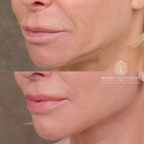 Beverly Hills Center Female Patient Before and After AuraLyft, Brow Lift, Upper Blepharoplasty, and CUPID LIFT® Lip Lift