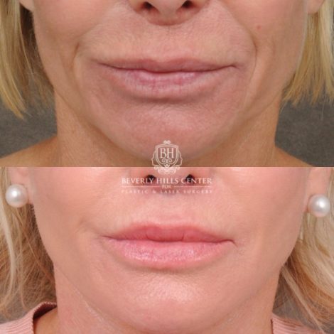 Beverly Hills Center Female Patient Before and After AuraLyft, Brow Lift, Upper Blepharoplasty, and CUPID LIFT® Lip Lift