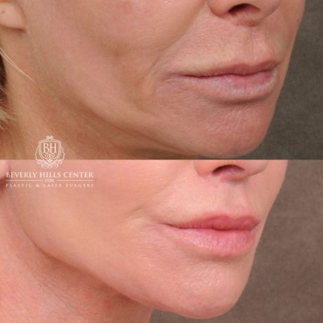 Beverly Hills Center Female Patient Before and After AuraLyft, Brow Lift, Upper Blepharoplasty, and CUPID LIFT® Lip Lift