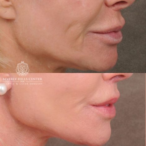 Beverly Hills Center Female Patient Before and After AuraLyft, Brow Lift, Upper Blepharoplasty, and CUPID LIFT® Lip Lift