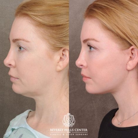 Beverly Hills Center Female Patient Before and After AuraLyft, CUPID LIFT®, Nanofat PRP