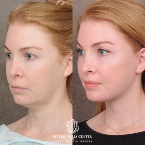 Beverly Hills Center Female Patient Before and After AuraLyft, CUPID LIFT®, Nanofat PRP