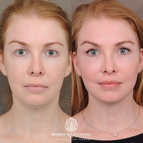 Beverly Hills Center Female Patient Before and After AuraLyft, CUPID LIFT®, Nanofat PRP