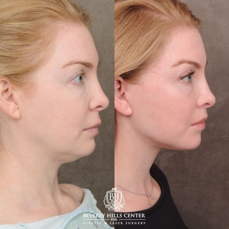 Beverly Hills Center Female Patient Before and After AuraLyft, CUPID LIFT®, Nanofat PRP