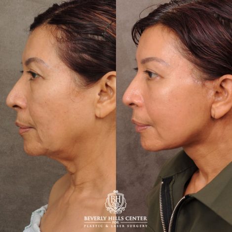 Beverly Hills Center Female Patient Before and After AuraLyft, Brow Lift, Lower Bllepharoplasty, and Fat Grafting