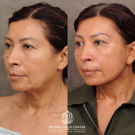 Beverly Hills Center Female Patient Before and After AuraLyft, Brow Lift, Lower Bllepharoplasty, and Fat Grafting