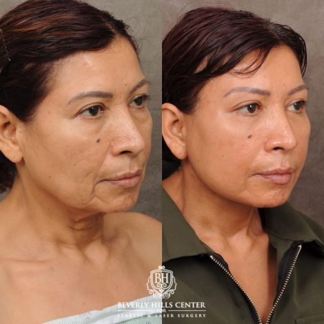 Beverly Hills Center Female Patient Before and After AuraLyft, Brow Lift, Lower Bllepharoplasty, and Fat Grafting