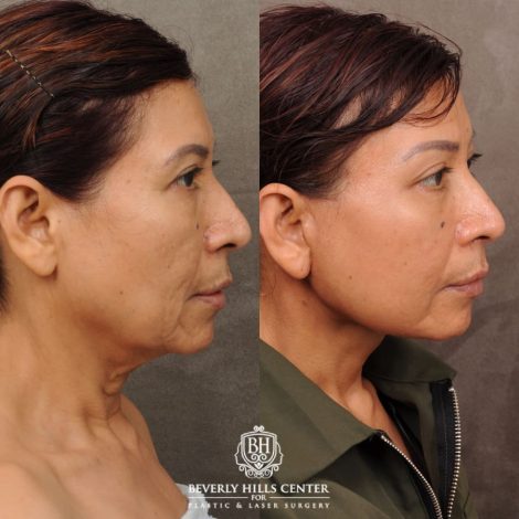 Beverly Hills Center Female Patient Before and After AuraLyft, Brow Lift, Lower Bllepharoplasty, and Fat Grafting