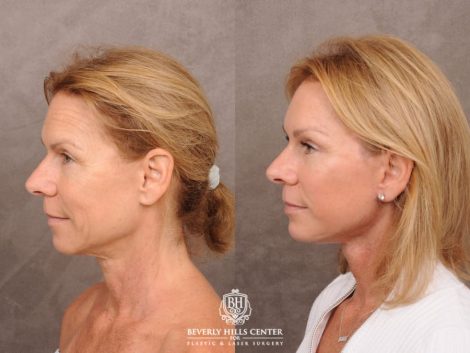 Beverly Hills Center Female Patient Before and After AuraLyft with Brow Lift and at Transfer