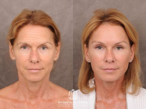 Beverly Hills Center Female Patient Before and After AuraLyft with Brow Lift and at Transfer