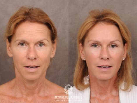 Beverly Hills Center Female Patient Before and After AuraLyft with Brow Lift and at Transfer