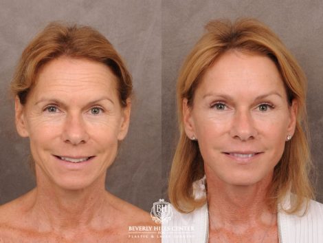 Beverly Hills Center Female Patient Before and After AuraLyft with Brow Lift and at Transfer