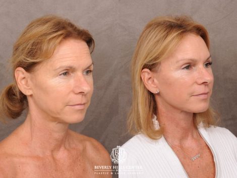 Beverly Hills Center Female Patient Before and After AuraLyft with Brow Lift and at Transfer