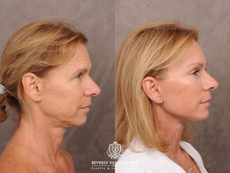 Beverly Hills Center Female Patient Before and After AuraLyft with Brow Lift and at Transfer