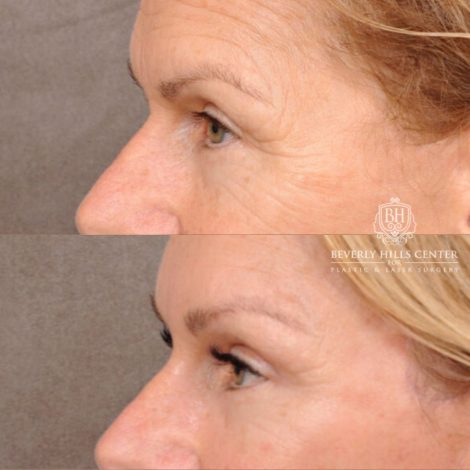 Beverly Hills Center Female Patient Before and After AuraLyft with Brow Lift and at Transfer