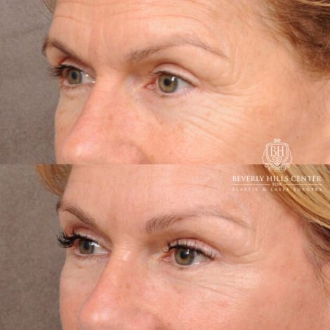 Beverly Hills Center Female Patient Before and After AuraLyft with Brow Lift and at Transfer