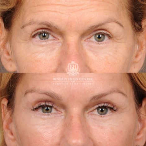 Beverly Hills Center Female Patient Before and After AuraLyft with Brow Lift and at Transfer
