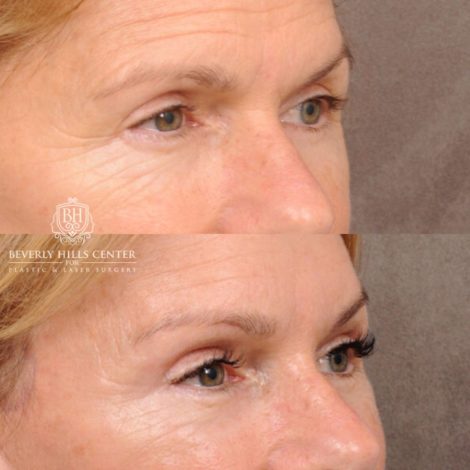 Beverly Hills Center Female Patient Before and After AuraLyft with Brow Lift and at Transfer