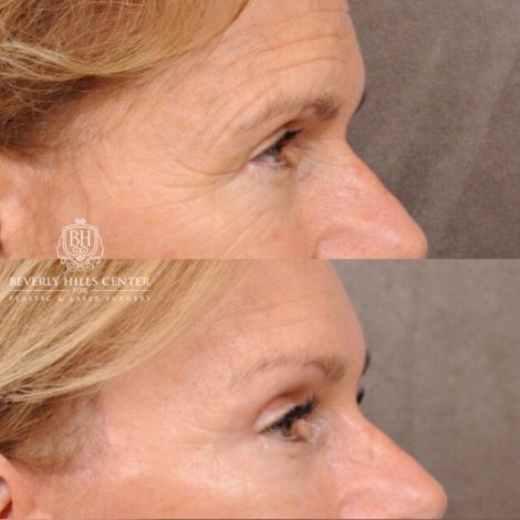 Beverly Hills Center Female Patient Before and After AuraLyft with Brow Lift and at Transfer