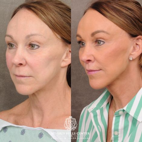 Beverly Hills Center Female Patient Before and After AuraLyft, CUPID LIFT®, Brow Lift, Upper Blepharoplasty