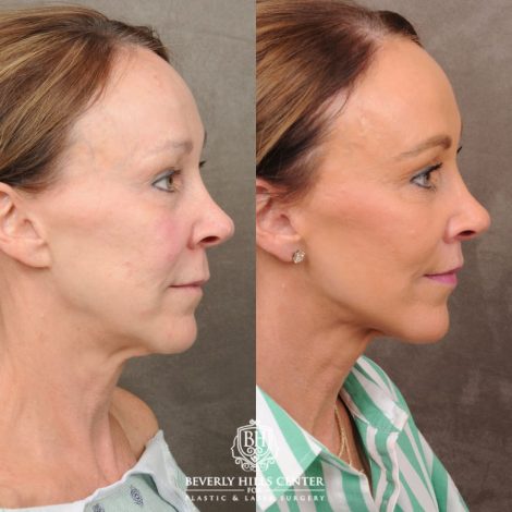 Beverly Hills Center Female Patient Before and After AuraLyft, CUPID LIFT®, Brow Lift, Upper Blepharoplasty