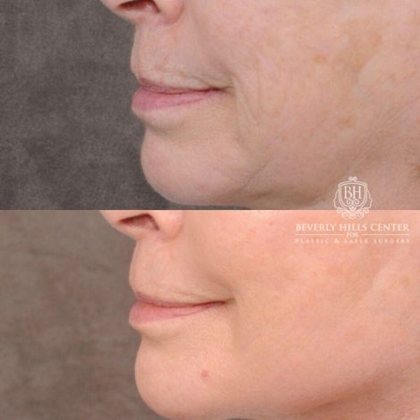 Beverly Hills Center Female Patient Before and After PHAT Lips