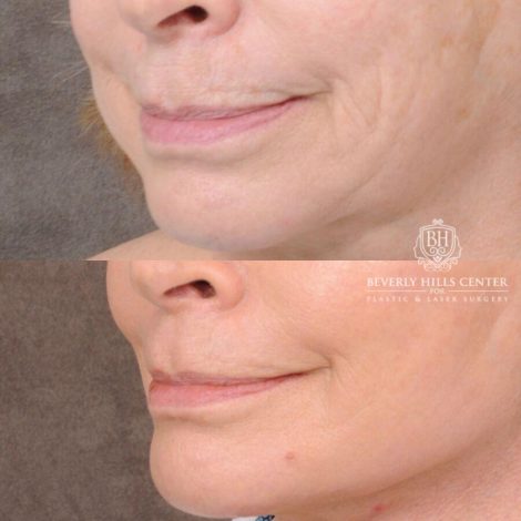 Beverly Hills Center Female Patient Before and After PHAT Lips