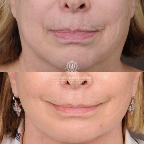 Beverly Hills Center Female Patient Before and After PHAT Lips