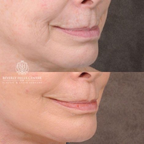 Beverly Hills Center Female Patient Before and After PHAT Lips
