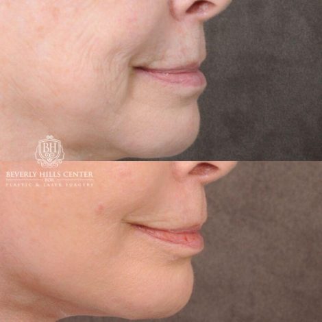 Beverly Hills Center Female Patient Before and After PHAT Lips