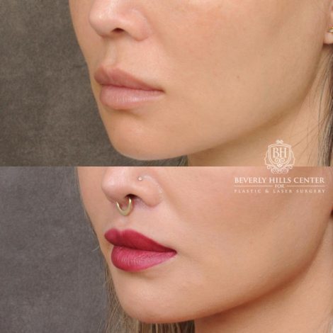 Beverly Hills Center Female Patient Before and After CUPID LIFT®