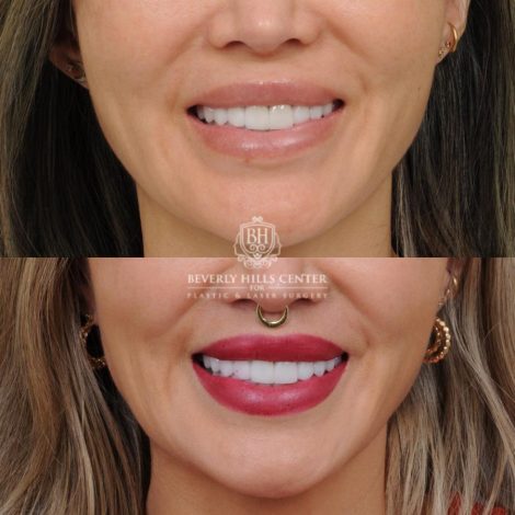 Beverly Hills Center Female Patient Before and After CUPID LIFT®