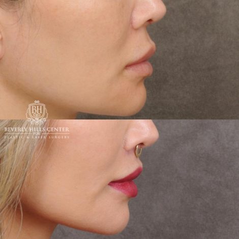 Beverly Hills Center Female Patient Before and After CUPID LIFT®